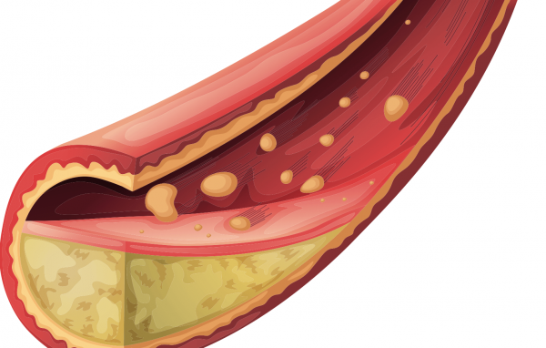 Hanna Saadeh - Cholesterol Treatment (The New Guidelines)